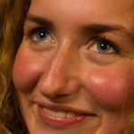 Rosácea, la enemiga del cutis