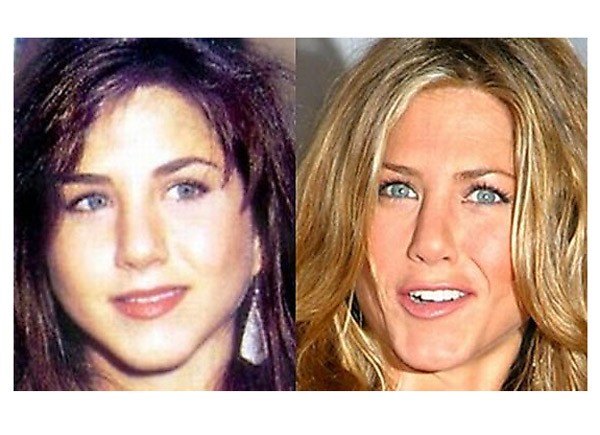 Jennifer Aniston Antes y despues de la cirugia